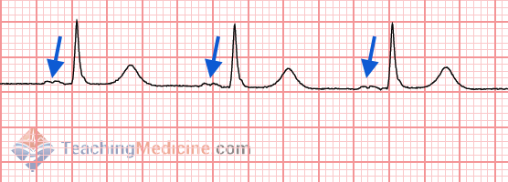 p-waves